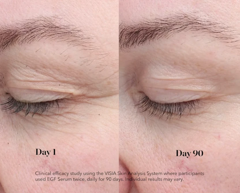 Клінічне дослідження EGF Serum у додатковій проекції: перший і дев'яностий день